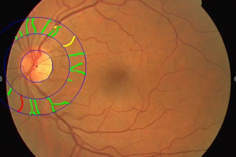 Augmented Fundus Image with Tortuosity Grading